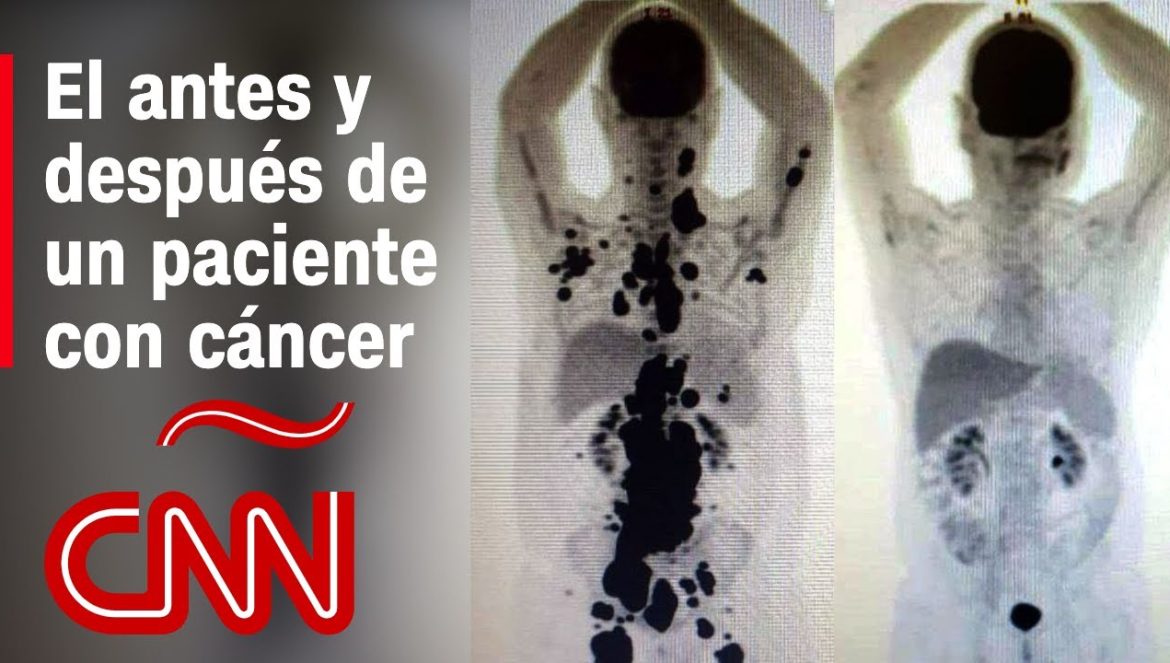 Antes y después de un paciente con cáncer que tuvo remisión en 1 mes gracias a terapia de células….06-05-2023