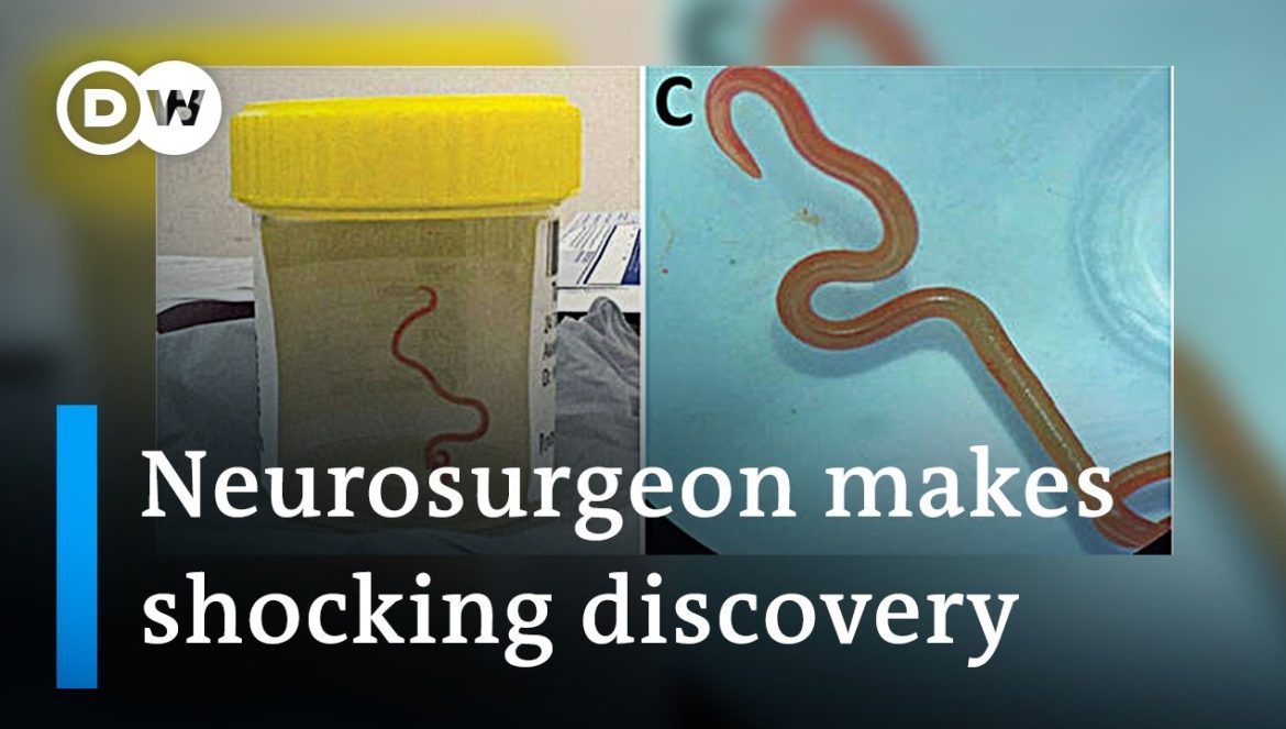 Neurosurgeon removes live worm from woman’s brain in world-first discovery….08-29-2023