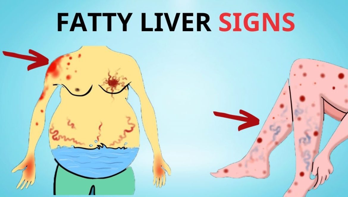 A Silent Threat: 8 Signs That Could Indicate Fatty Liver Disease | 11-22-2023