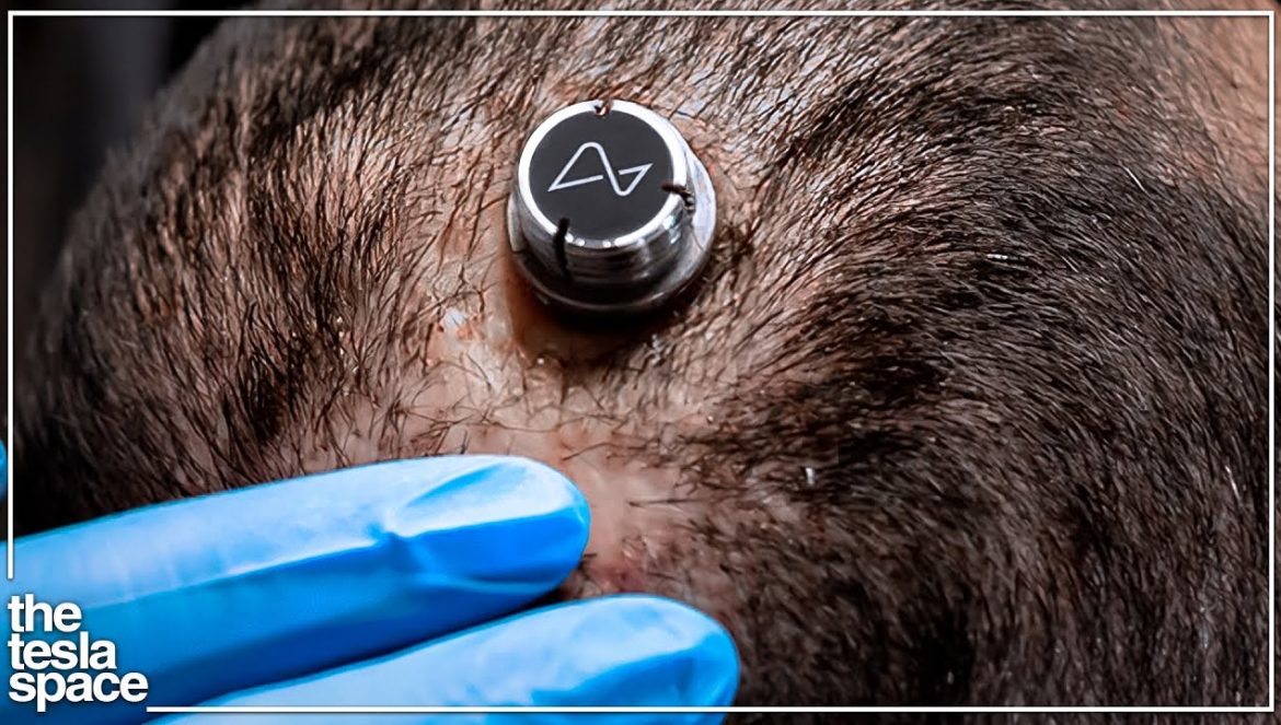 Neuralink Begins First Human Experiments….02-04-2024