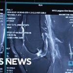 Breakthrough MRI technology uses AI for faster scans….04-26-2024