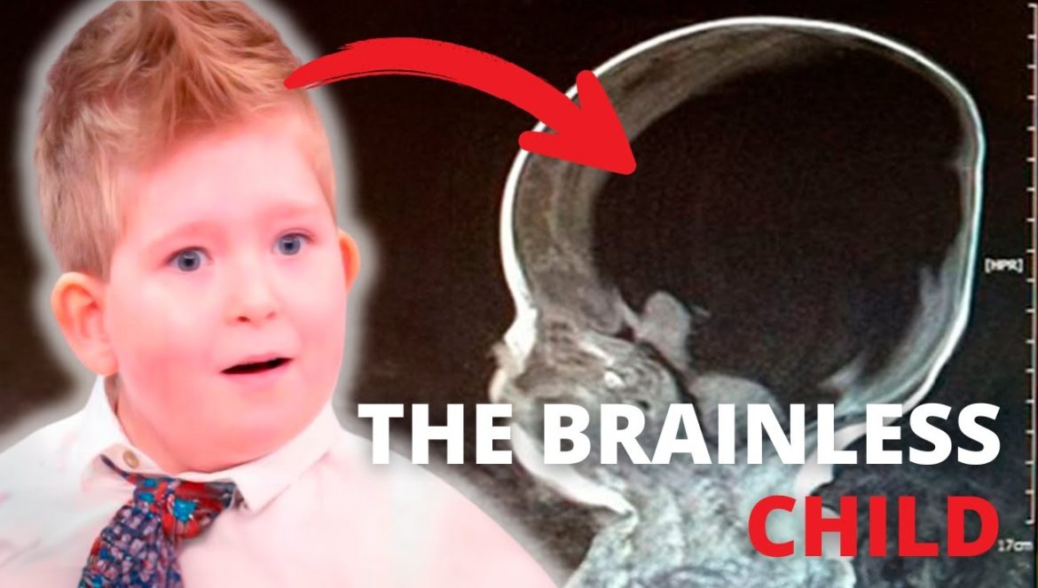 Can we LIVE without a BRAIN? | The CASE of NOAH WALL and 3 Others May Provide the Answer….04-16-2024