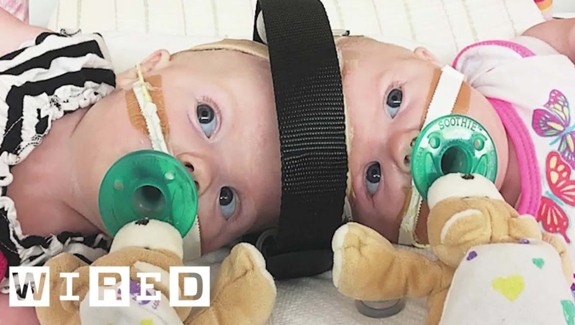 Surgeons Break Down Separating Conjoined Twins….07-26-2022
