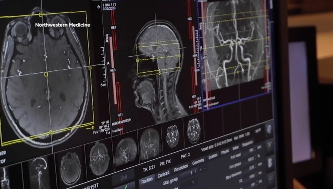 New study from SF Gladstone Institutes sheds light on cause of brain fog due to COVID-19….09-28-2024