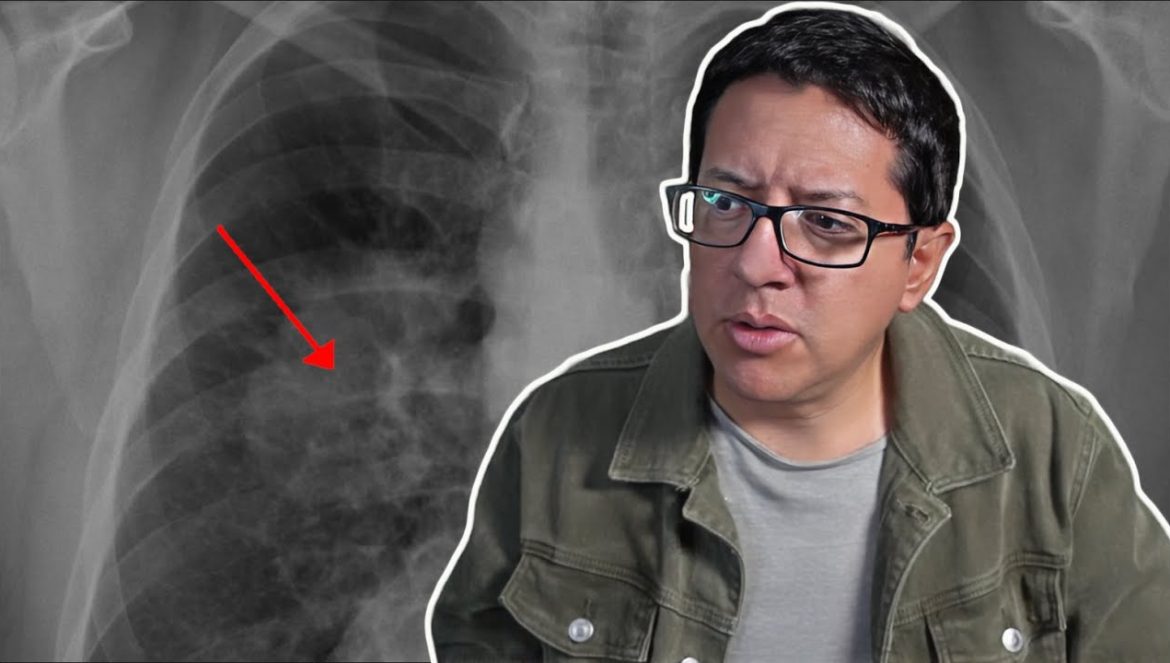 El Cáncer de Pulmón está Aumentando Entre los NO FUMADORES….02-18-2025